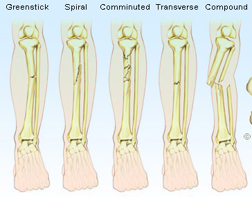 Types of forearm fractures www.emedicine.com