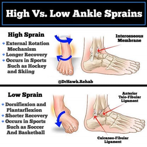 Ankle Sprain or Ligament Injury - Bunbury Foot & Ankle Surgeon